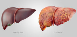 Healthy Liver vs Unhealthy Liver